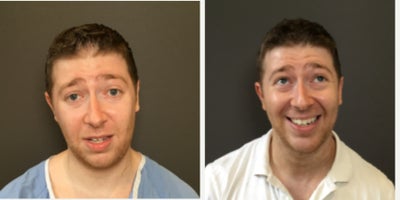 Chin Implant before and after photo
