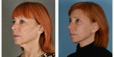 Facelift before and after photo