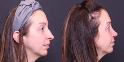 Rhinoplasty before and after photo