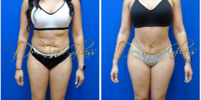 Tummy Tuck before and after photo