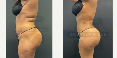 Abdominal Etching before and after photo