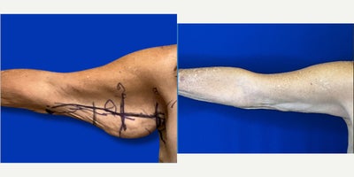 Arm Lift before and after photo