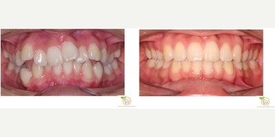 Braces before and after photo