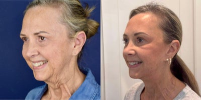 Eyelid Surgery before and after photo
