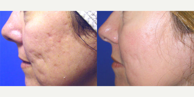 Fraxel Laser before and after photo