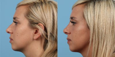 Rhinoplasty before and after photo