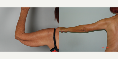 Arm Lift before and after photo