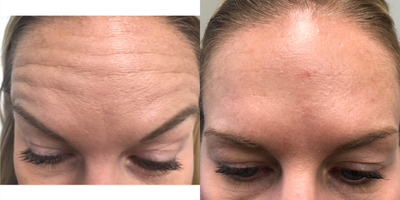 Botox before and after photo