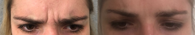 Botox before and after photo