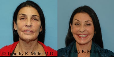 Facelift before and after photo