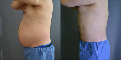 Laser Liposuction before and after photo
