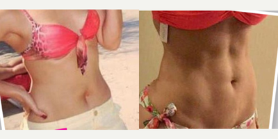 Liposculpture before and after photo