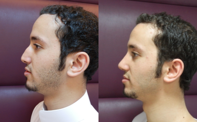 Revision Rhinoplasty before and after photo