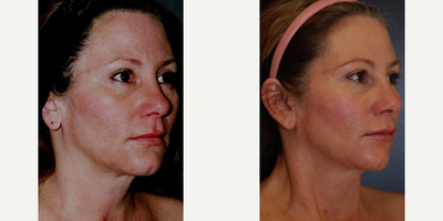 Thread Lift before and after photo