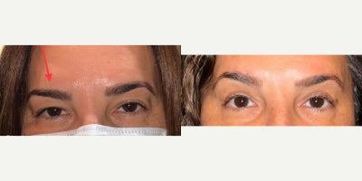 Brow Lift before and after photo