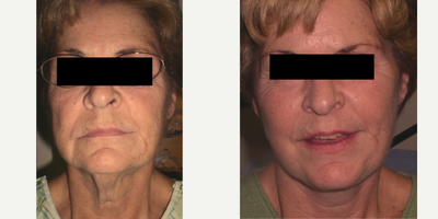Facelift before and after photo