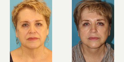 Facelift before and after photo