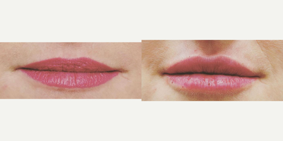 Lip Fillers before and after photo