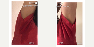 MiraDry before and after photo