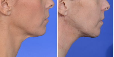 Neck Lift before and after photo