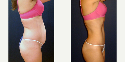 Tummy Tuck before and after photo