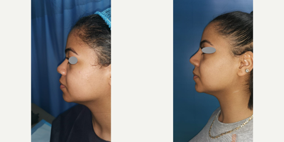 African American Rhinoplasty before and after photo