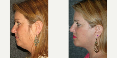 Chin Liposuction before and after photo