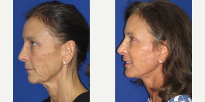 Eyelid Surgery before and after photo