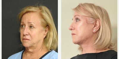 Neck Lift before and after photo