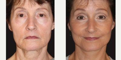 Deep Plane Facelift before and after photo