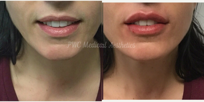 Dermal Fillers before and after photo