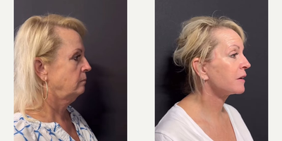 Facelift before and after photo