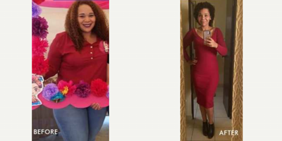Gastric Bypass before and after photo