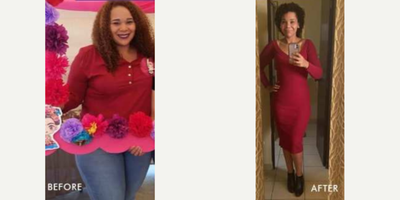 Gastric Bypass before and after photo