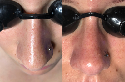 HydraFacial before and after photo