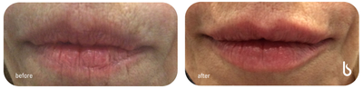 Lip Fillers before and after photo