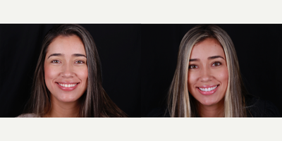Porcelain Veneers before and after photo