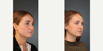 Rhinoplasty before and after photo