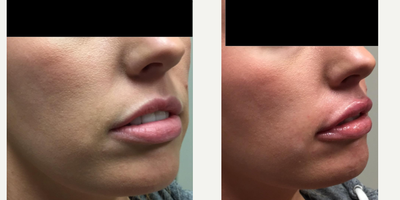 Vollure before and after photo