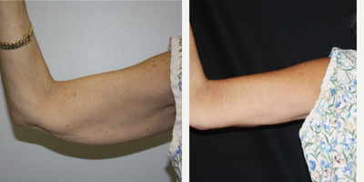 Arm Lift before and after photo
