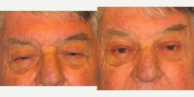 Brow Lift before and after photo