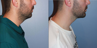 Chin Implant before and after photo