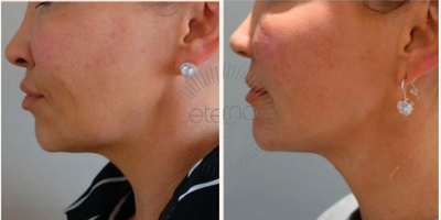 Dermal Fillers before and after photo