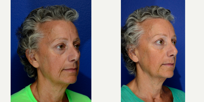 Dermal Fillers before and after photo