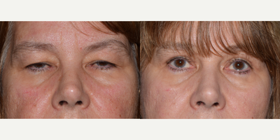Eyelid Surgery before and after photo