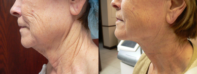 Fractional Laser before and after photo
