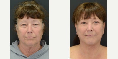 Lower Facelift before and after photo