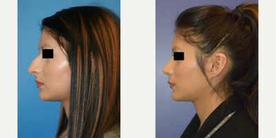 Rhinoplasty before and after photo