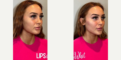 Botox before and after photo