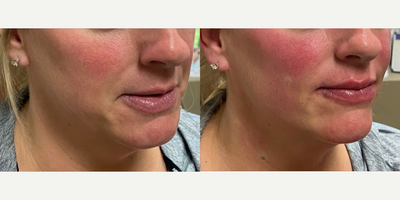 Botox before and after photo